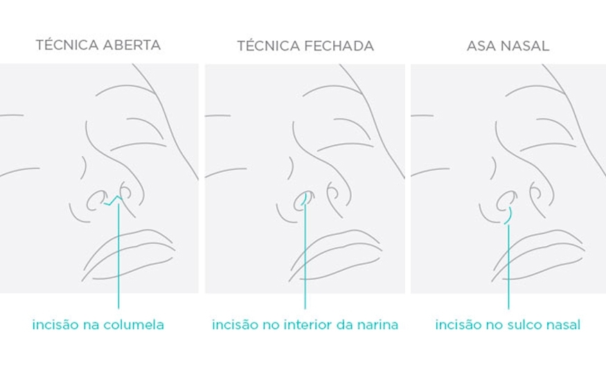 A ASA NASAL