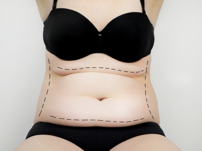 Abdominoplastia ou Lipoaspiração: qual a melhor escolha para cada caso?