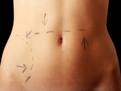 Como manter os resultados da abdominoplastia?