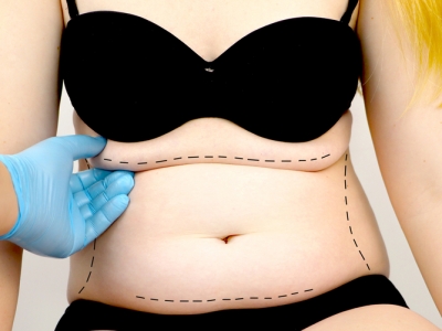 Abdominoplastia após gravidez: Restaurando o corpo e a autoconfiança