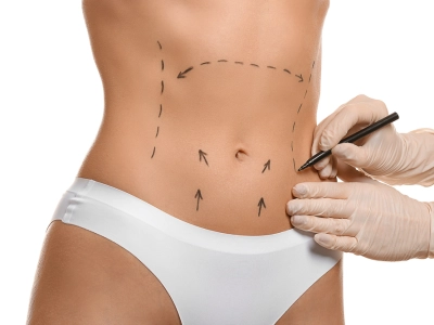Cirurgia no abdômen: como a abdominoplastia pode mudar sua autoestima