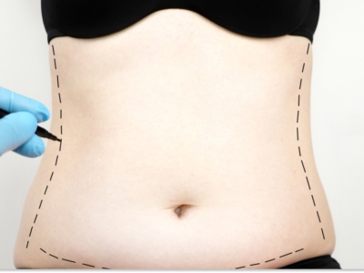 Abdominoplastia pós-parto: recuperando a forma física