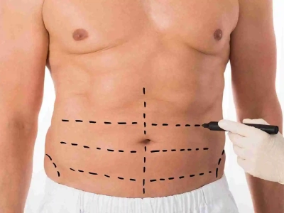 O que é lipo HD, como funciona e quando é indicada?