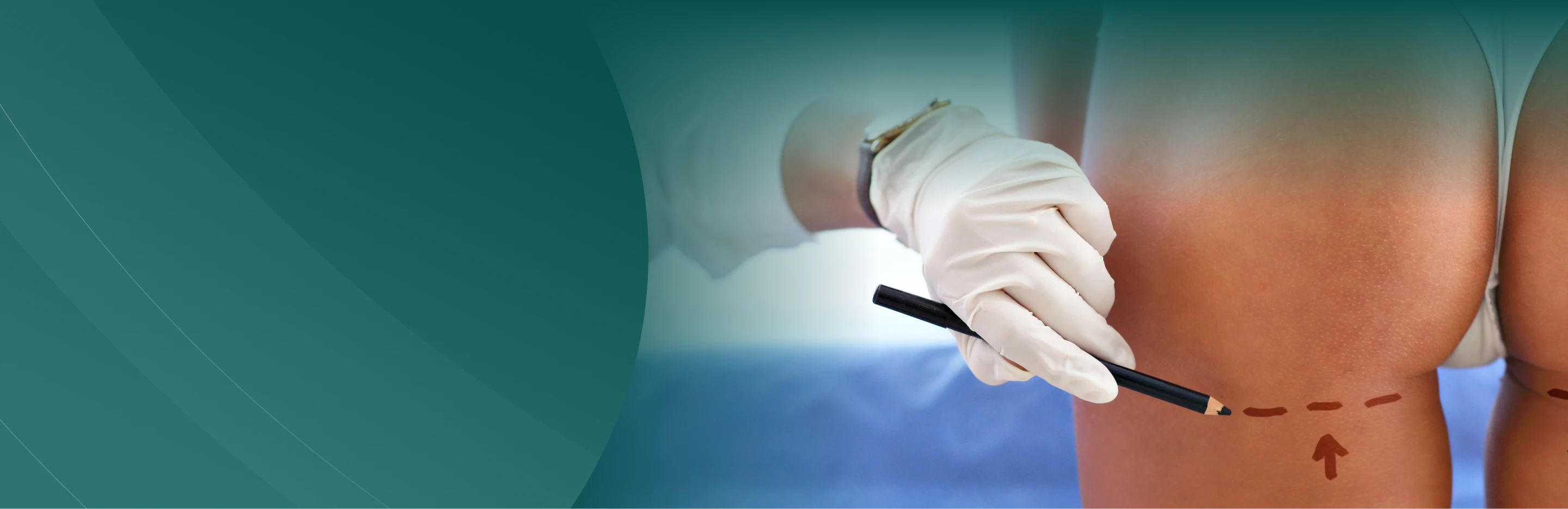 Gluteoplastia&nbsp;(Pr&oacute;tese de Gl&uacute;teo)