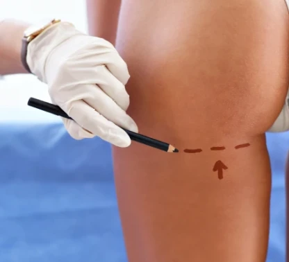 Gluteoplastia (Prótese de Glúteo)