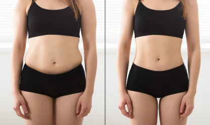 Quanto tempo duram os resultados do Mommy Makeover?