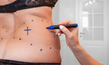 Lipoaspiração: o que é, tipos e qual o tempo de recuperação?