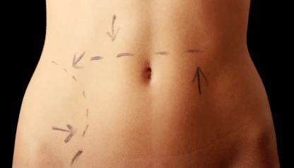 Abdominoplastia: Como funciona a recuperação e os cuidados pós-operatórios