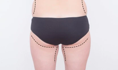 Como é feito o implante de silicone no Glúteo?