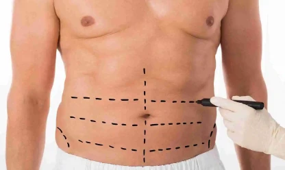 O que é lipo HD, como funciona e quando é indicada?