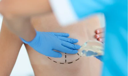 Com quantos anos pode fazer mamoplastia redutora?