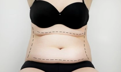 Abdominoplastia em pacientes com sobrepeso