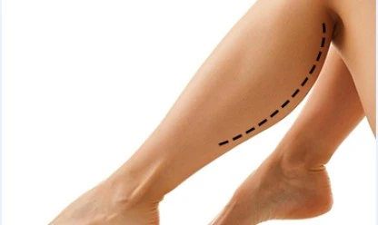 Prótese de panturrilha: como funciona e quando é indicado