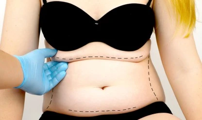 Abdominoplastia após gravidez: Restaurando o corpo e a autoconfiança