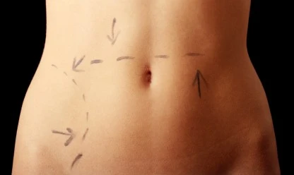 Como manter os resultados da abdominoplastia?