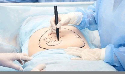 Como é a recuperação de uma lipoaspiração?