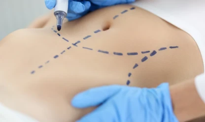 O que esperar do pós-operatório do mommy makeover