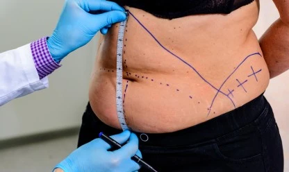 Preparo para uma abdominoplastia: dicas e orientações