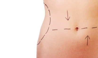 Lipoaspiração no abdome: quais cuidados devo ter antes e depois da cirurgia?