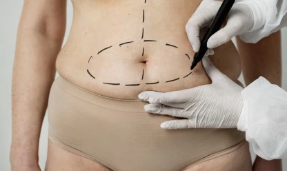 Cirurgia para tirar barriga: como a abdominoplastia pode transformar seu corpo
