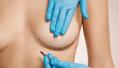 Recuperação pós-mamoplastia de aumento: Guia completo para uma transição suave