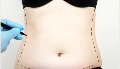 Abdominoplastia pós-parto: recuperando a forma física