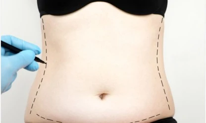 Abdominoplastia pós-parto: recuperando a forma física